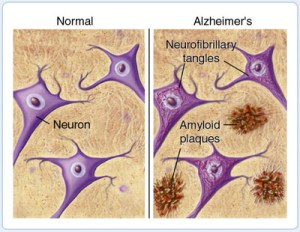 Plaques and Tangles in Alzheimer's Disease