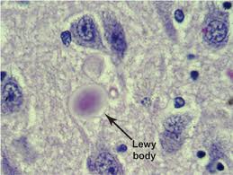 Lewy Body Protein - Lewy Body dementia