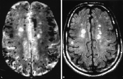 small-vessel-ischemia-brain-mri