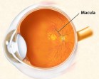 dry macular degeneration