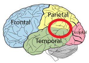 temporoparietal-junction-rem-behavior-disorder-lewy-body-dementia