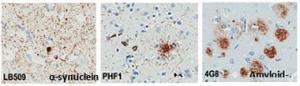 Toxic protein deposits of α-synuclein, tau, and Aβ damage different areas of the brain in Lewy Body dementia