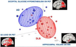 In this study of 21 patients, each with DLB or AD, three imaging methods combined distinguished the two better than each individual scan. Except for one DLB patient, all AD and DLB patients are separated using multimodality imaging measures.