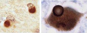 side by side microscopic view of Lewy Body proteins in Lewy Body dementia and Parkinson's Disease