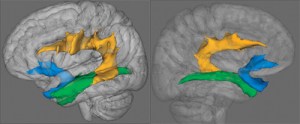 Neurological distribution of primary progress aphasia (PPA)