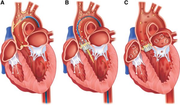 Transcatheter Aortic Valve Replacement